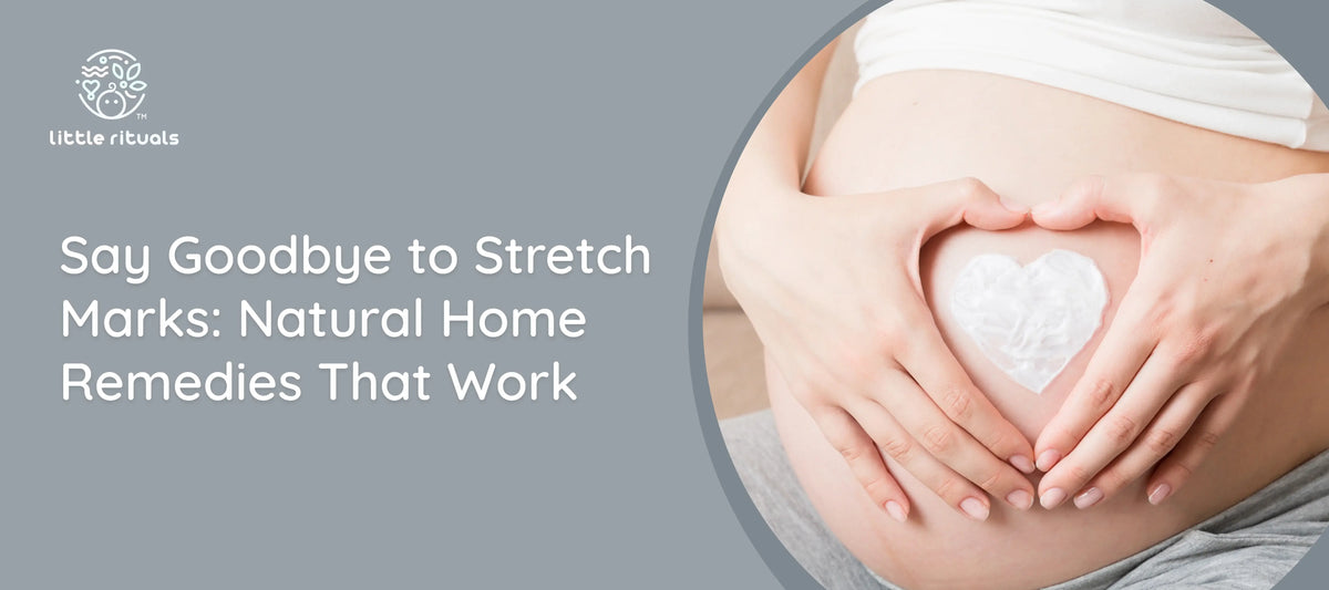 Say Goodbye to Stretch Marks: Natural Home Remedies That Work