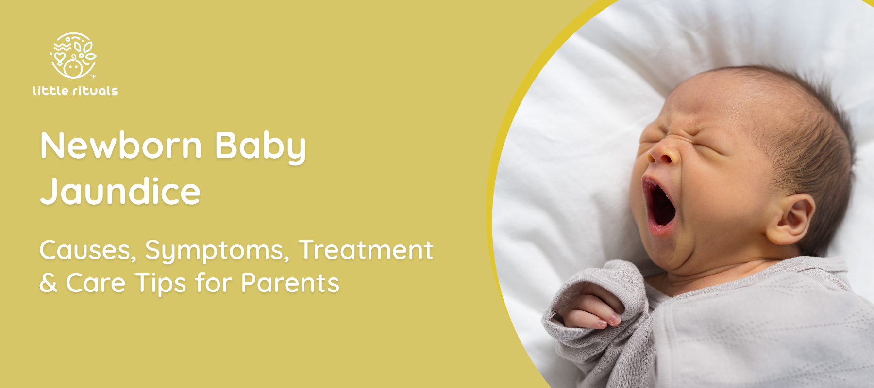 newborn baby jaundice