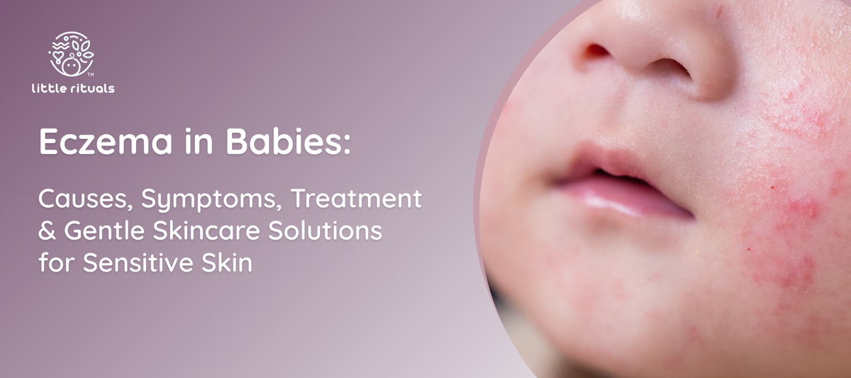 eczema in babies